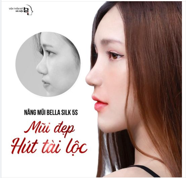 Nâng mũi Bella Silk 5S - Mũi đẹp hút TÀI LỘC