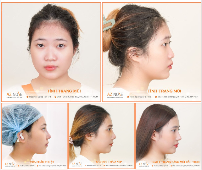 Khắc phục mũi thấp - g.ồ cho nữ sinh 2K3!!