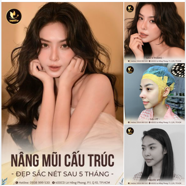feedback Nàng mẫu ảnh Trân Hoàng tự tin khoe diện mạo sắc nét sau 5 tháng nâng mũi cấu trúc sụn Surgiform!