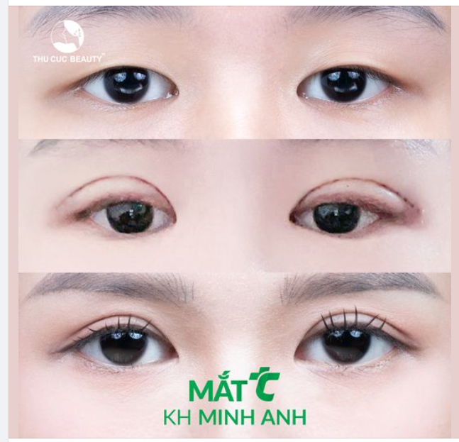 Hành trình cắt mí của KH Kim Anh