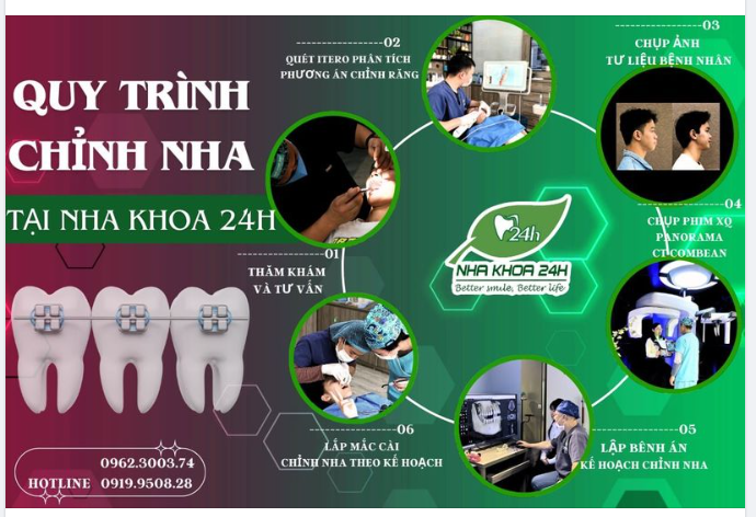 QUY TRÌNH CHỈNH NHA CHUYÊN NGHIỆP TẠI NHA KHOA 24H TP. HÒA BÌNH