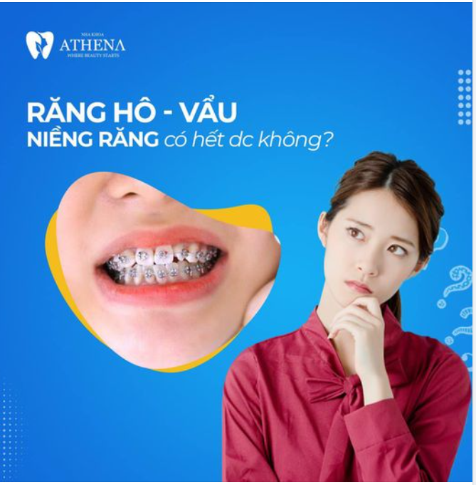 Răng vẩu (hay còn gọi là răng hô) là tình trạng hàm trên nhô ra trước khiến bạn bị tự ti trong giao tiếp hàng ngày.