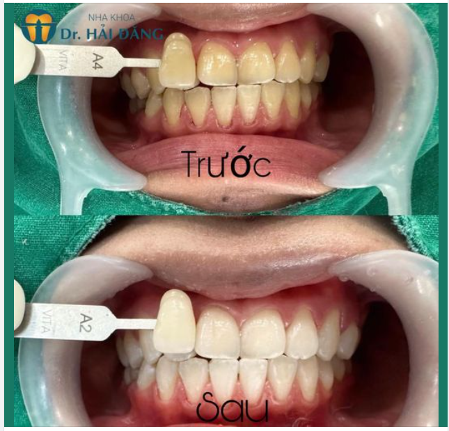 TẨY TRẮNG RĂNG - LUNG LINH ĐÓN HÈ