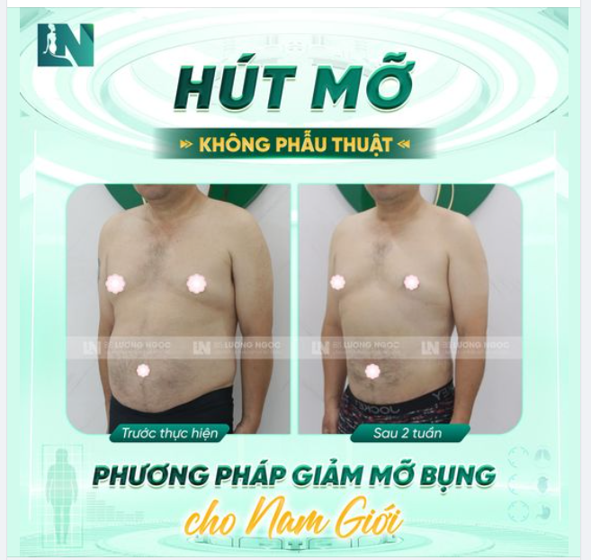 TẠM BIỆT "BỤNG BIA" - GIỮ VỮNG PHONG ĐỘ PHÁI MẠNH VỚI PHƯƠNG PHÁP HÚT MỠ TẠO DÁNG