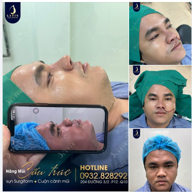 Mũi cấu trúc sụn tai cho anh trai đến từ Trà Vinh