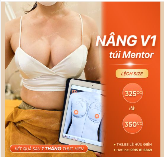 Nâng ngực MENTOR, KHỎI LO VỀ CHI PHÍ