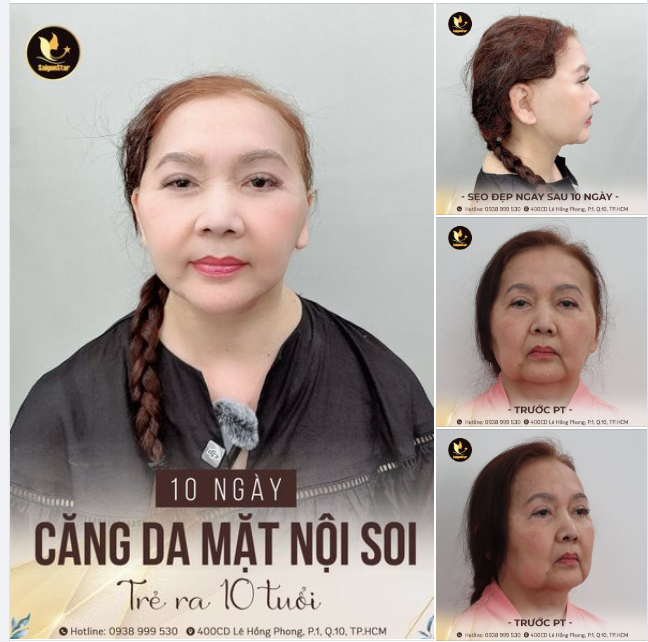 LÃO HÓA NGƯỢC CHỈ SAU 10 NGÀY CĂNG DA MẶT NỘI SOI