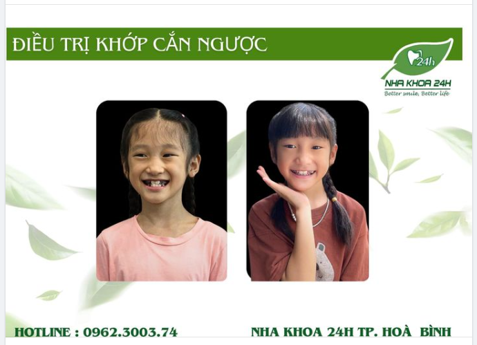 NIỀNG RĂNG SỚM – MÓN QUÀ VÔ GIÁ CHO TƯƠNG LAI