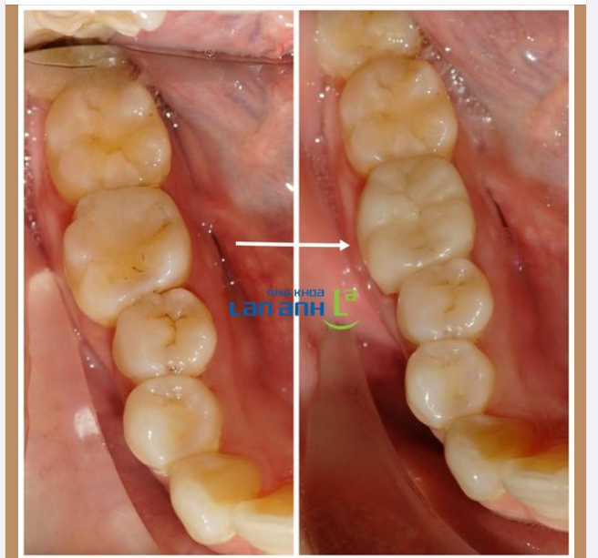 Phục hình sứ cho răng đã điều trị tuỷ