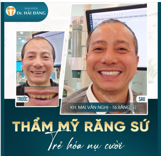 THẨM MỸ RĂNG SỨ TRẺ HOÁ NỤ CƯỜI