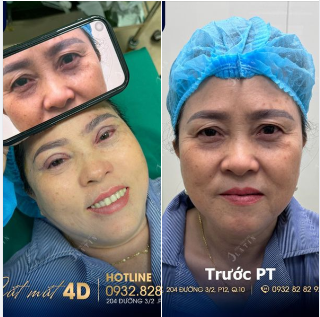 Cắt mí trẻ hóa mắt siêu đẹp cho cô khách trung niên