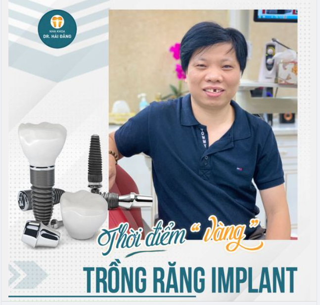 Thời điểm vàng để Trồng răng Implant?