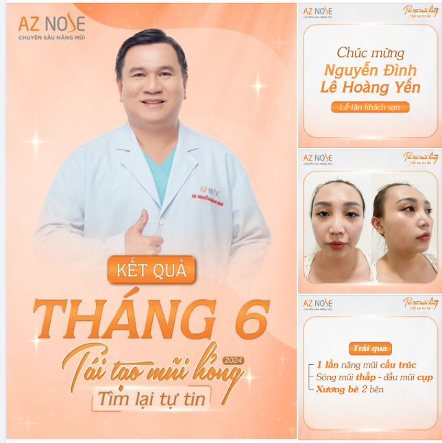 Tái tạo mũi h.ỏng 2024 Chúc mừng khách hàng Hoàng Yến!