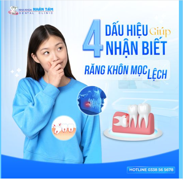 4 Dấu Hiệu Giúp Nhận Biết Răng Khôn Mọc Lệch