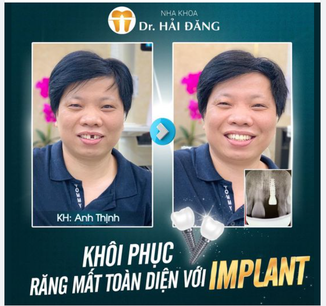 TRỒNG RĂNG IMPLANT THAY THẾ RĂNG ĐÃ MẤT