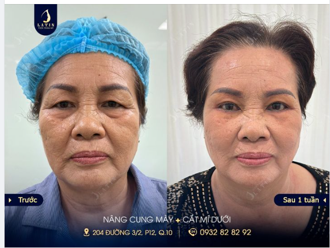 Combo Nâng cung mày - Cắt mí dưới sau 7 ngày cho cô khách Việt kiều Úc.