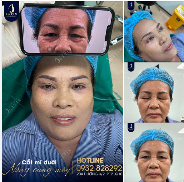 Cô khách trẻ hơn nhiều tuổi sau khi Nâng cung mày, cắt mí dưới tại Latin