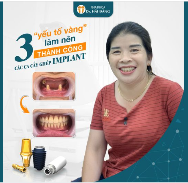 Tự hào là một trong những nha khoa hàng đầu về cấy ghép Implant, Nha khoa Hải Đăng đã và đang thu hút một lượng lớn khách đến làm dịch vụ.