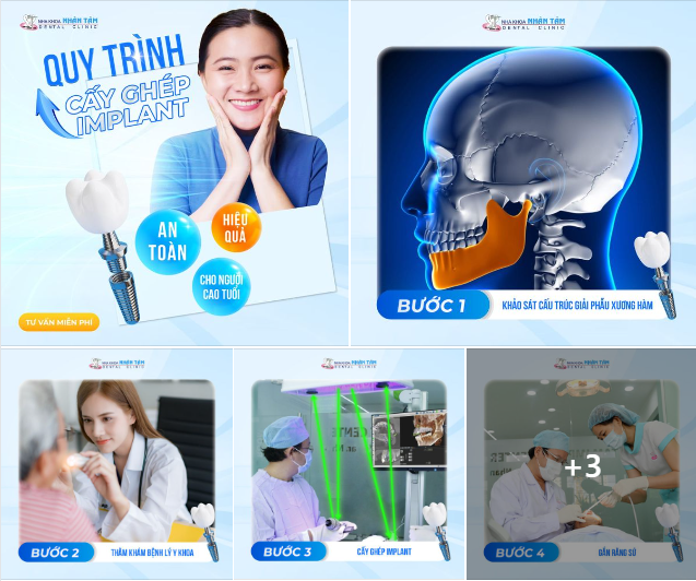 Quy trình cấy ghép Implant An toàn - Hiệu quả cho người cao tuổi