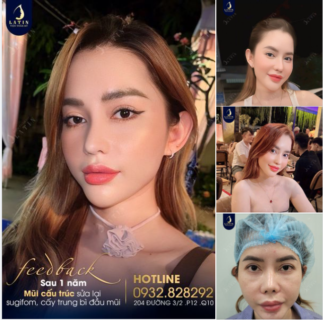 Khách hàng xinh đẹp, tự tin sau 1 năm sửa mũi tại Latin