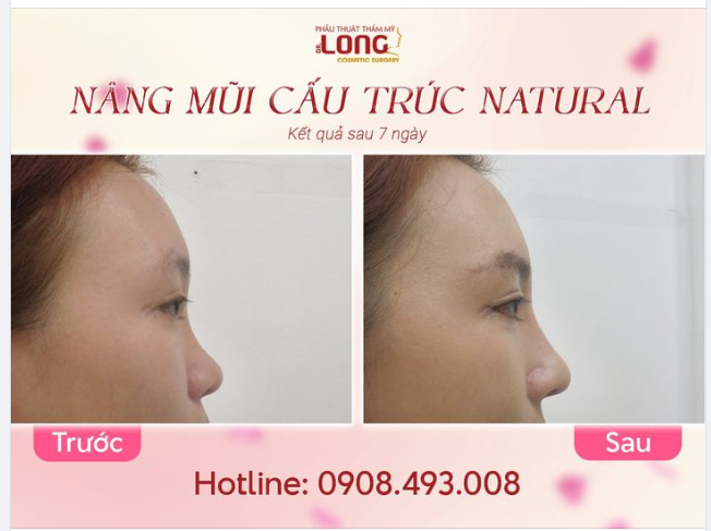 CHỈ CẦN 3 “CHỊU” ĐÃ CÓ DÁNG MŨI NHƯ MƠ