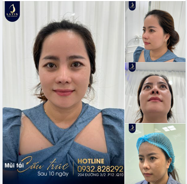 Mũi sửa lại 10 ngày lên dáng tự nhiên cho chị gái