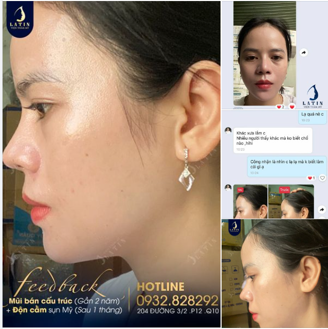 Đến Latin với chiếc cằm ngắn và lẹm, khiến gương mặt chị K.D thiếu sự thanh thoát
