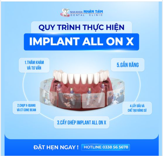 Quy trình thực hiện Implant All On X tại Nha khoa Nhân Tâm: