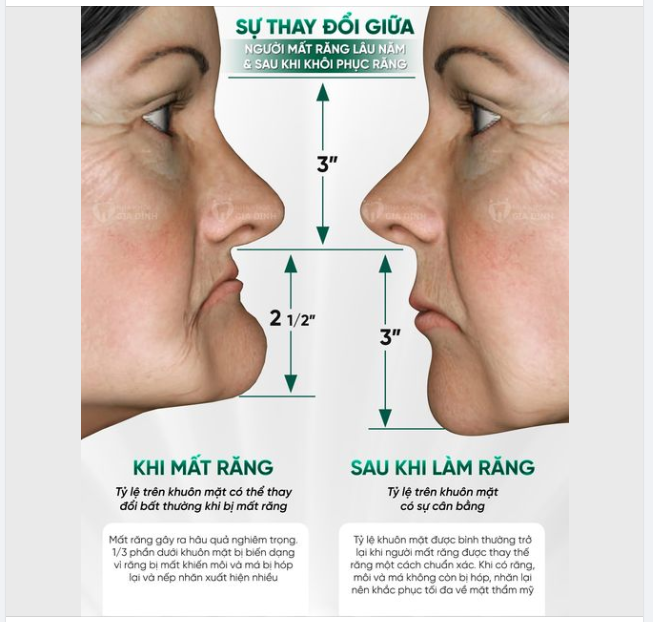 SỰ THAY ĐỔI GIỮA NGƯỜI MẤT RĂNG LÂU NĂM VÀ SAU KHI PHỤC HÌNH RĂNG