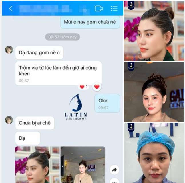 Thành quả sau 2 tháng nâng mũi cấu trúc tại Latin là 1 dáng mũi quá đẹp và tự nhiên