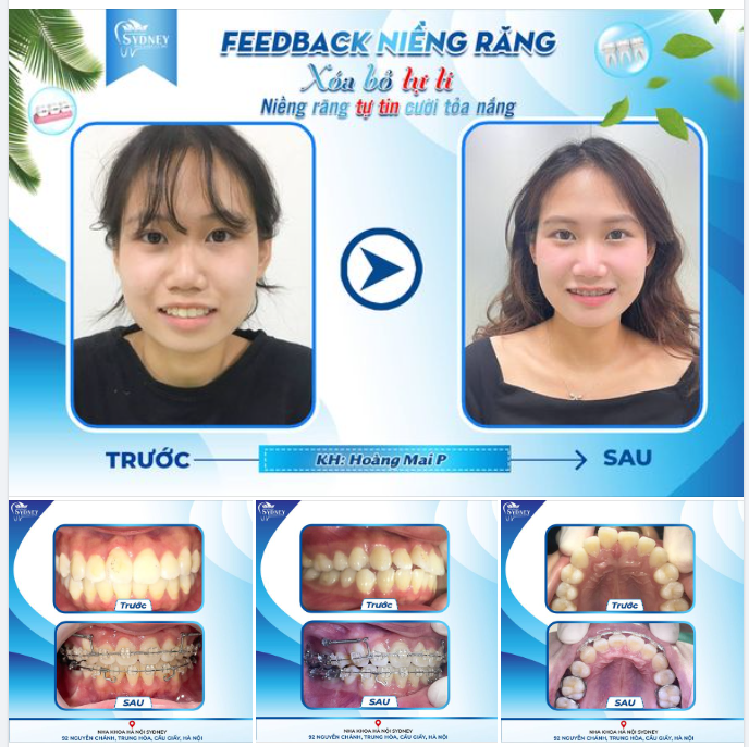 XÓA BỎ TỰ TI - NIỀNG RĂNG TỰ TIN CƯỜI TỎA NẮNG