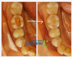 Trước đây chúng ta thường nghĩ đến bọc răng sứ cho những trường hợp răng sâu vỡ lớn. Tuy nhiên, khi bọc răng sứ thì răng sẽ bị mài nhỏ đi khá nhiều và mài cả vào những phần mô răng còn tốt.