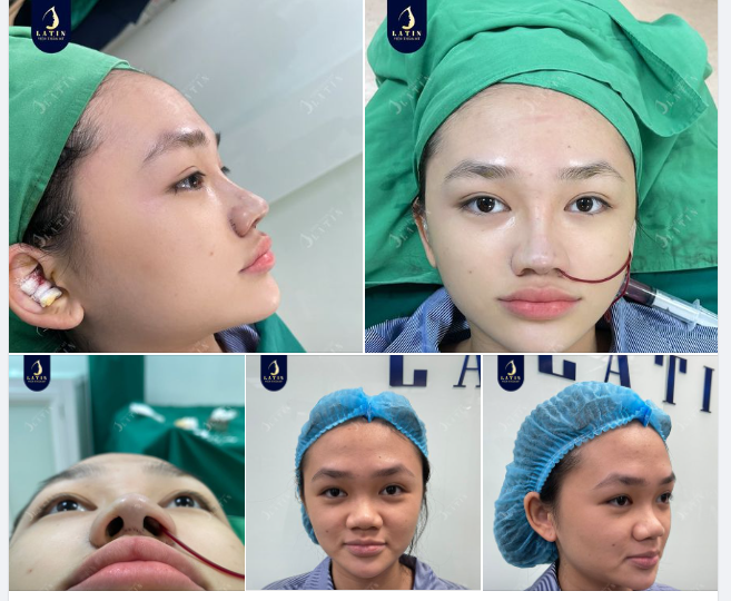 Khi chiếc mũi quyết định 80% nét đẹp khuôn mặt...