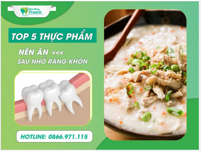 Top 5 thực phẩm nên ăn sau khi nhổ răng khôn.