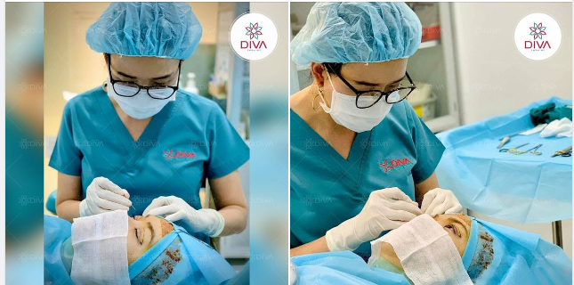 BÍ QUYẾT ĐỂ SAU CẮT MÍ MẮT MÍ KHÔNG BỊ THÔ, TO LÀ GÌ ?