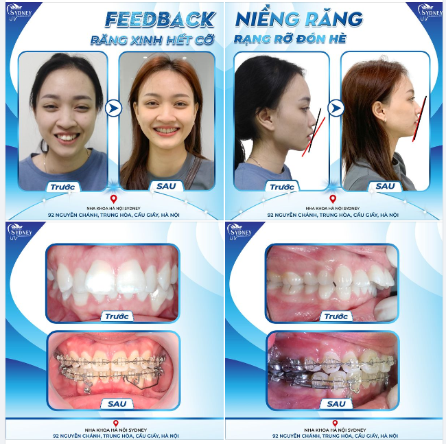 RĂNG XINH HẾT CỠ - RẠNG RỠ ĐÓN HÈ