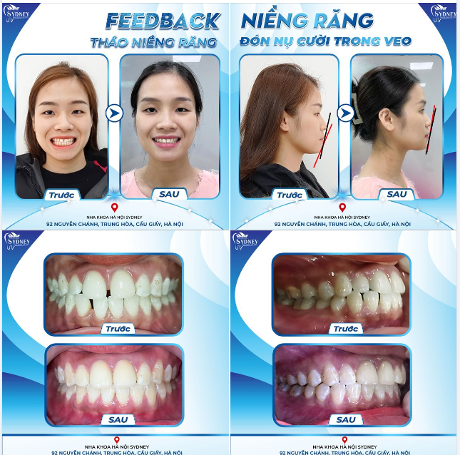 THÁO NIỀNG RĂNG - ĐÓN NỤ CƯỜI TRONG VEO