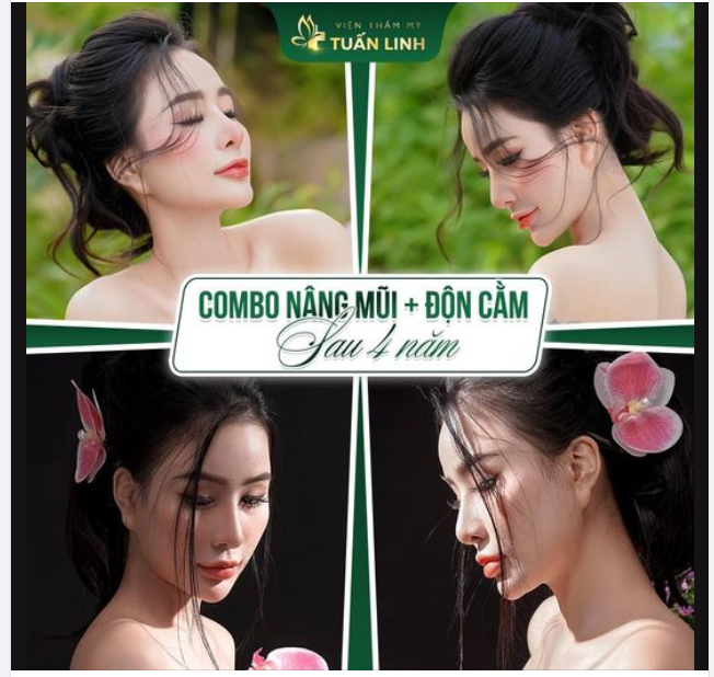 Đẹp quyến rũ với combo Mũi + Cằm sau 4 năm làm tại Tuấn Linh!!