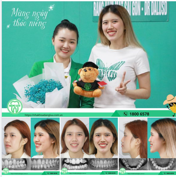 RĂNG XINH, KHỚP CẮN CHUẨN... ĐÃ ĐẾN LÚC THÁO NIỀNG!!!