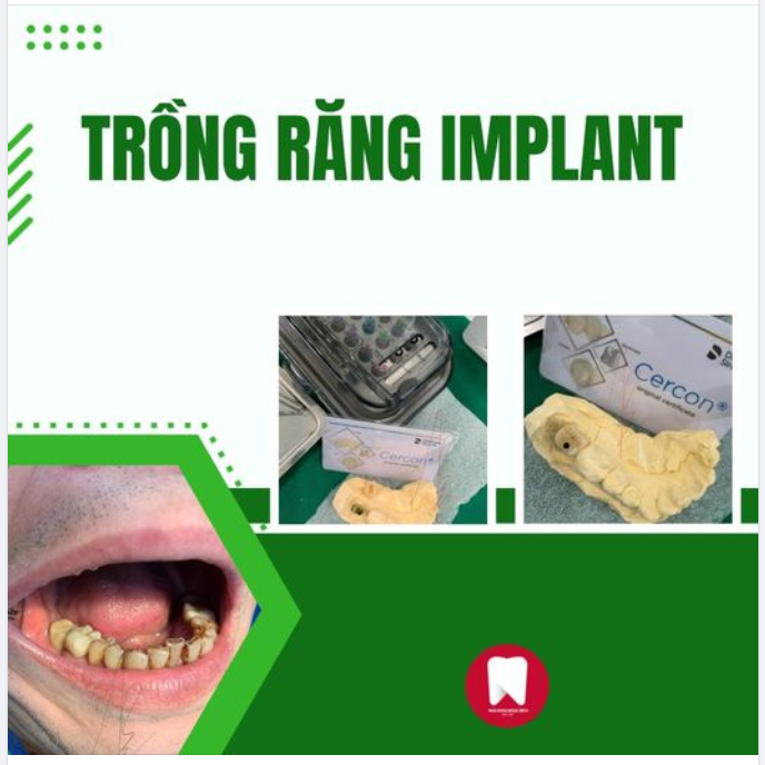 CÁC TRƯỜNG HỢP NÊN TRỒNG RĂNG IMPLANT