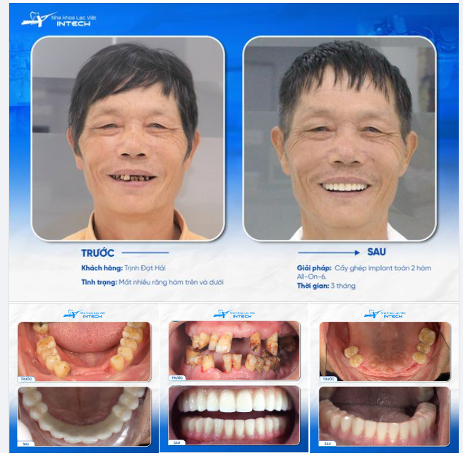 "TỪ NGÀY CÓ RĂNG MỚI, NỤ CƯỜI CỦA TÔI NHƯ ĐƯỢC HỒI SINH"