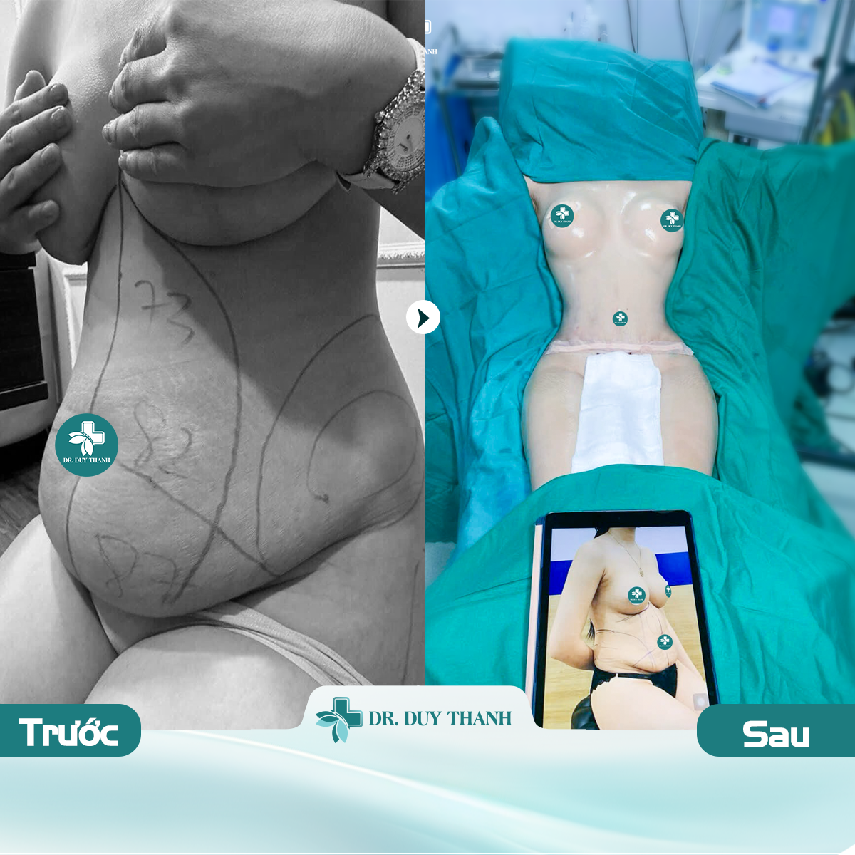 Chị gái 3 con đổi dáng ngoạn mục nhờ Dr Duy Thanh