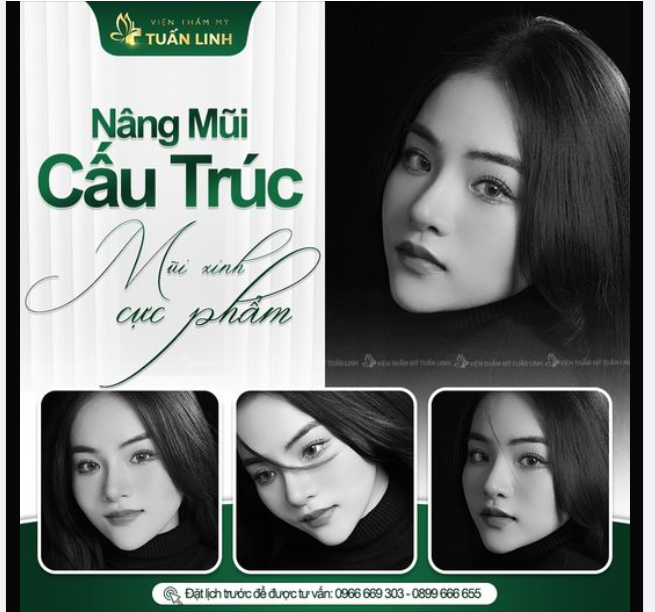 Nâng mũi cấu trúc - Mũi xinh cực phẩm!!