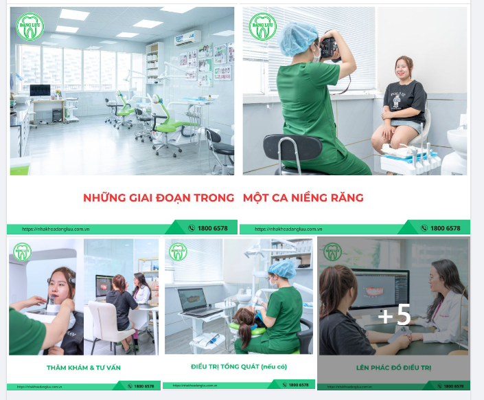 MỘT CA NIỀNG RĂNG BÌNH THƯỜNG SẼ TRẢI QUA NHỮNG GIAI ĐOẠN NÀO?