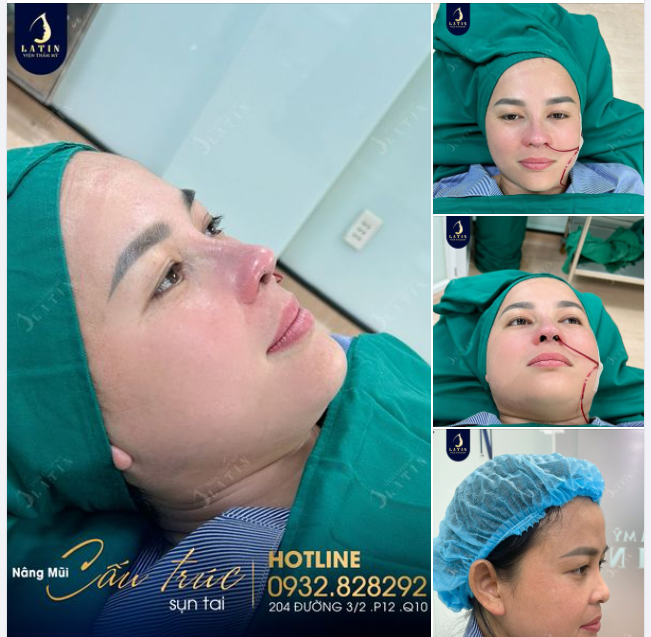 Mũi cấu trúc sụn tai cho chị gái thích dáng tự nhiên hợp mặt