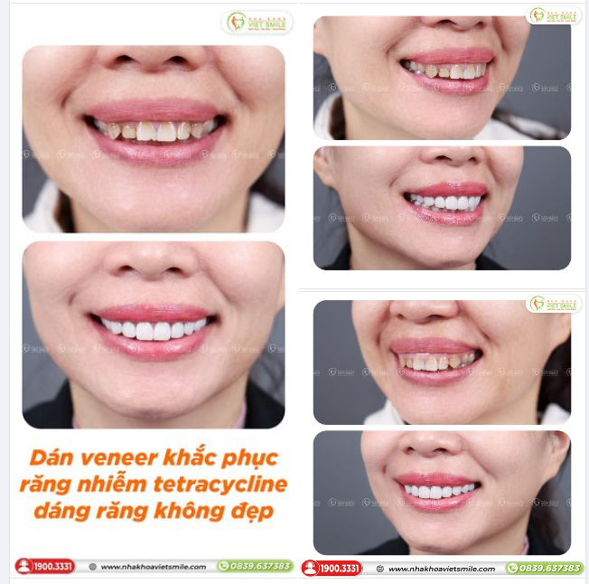 DÁN VENEER KHẮC PHỤC RĂNG NHIỄM TETRACYCLINE, DÁNG RĂNG KHÔNG ĐẸP