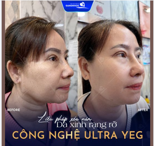 CÔNG NGHỆ ULTRA YEG Liệu pháp trị nám cho da sáng đẹp