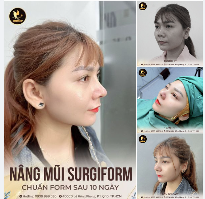 Chỉ một thay đổi nhỏ, cũng đủ làm sáng bừng cả một gương mặt Vậy nên người ta thường bảo "dáng mũi quyết định 70% nhan sắc" là đâu có sai đúng không cả nhà!!!