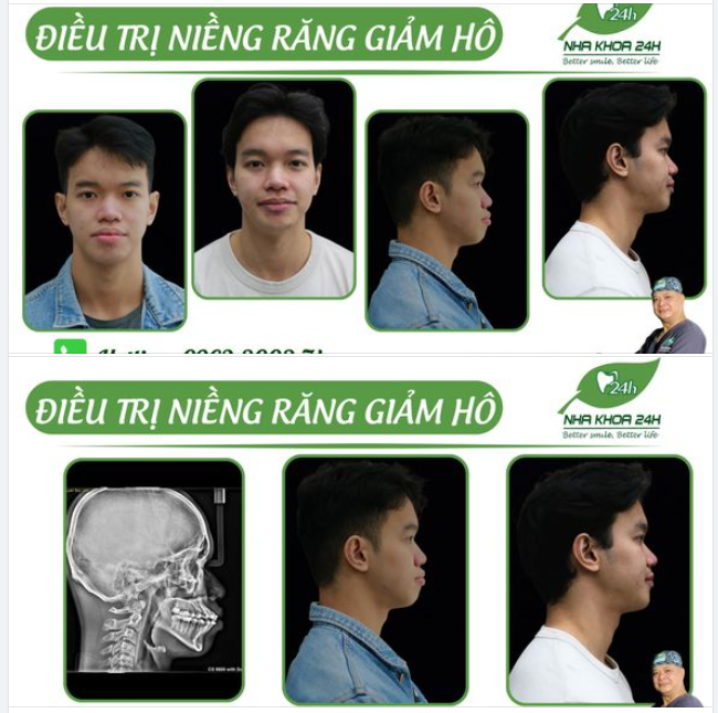 NIỀNG RĂNG SỚM CHO CON HÀNH TRANG TỰ TIN BƯỚC VÀO ĐỜI