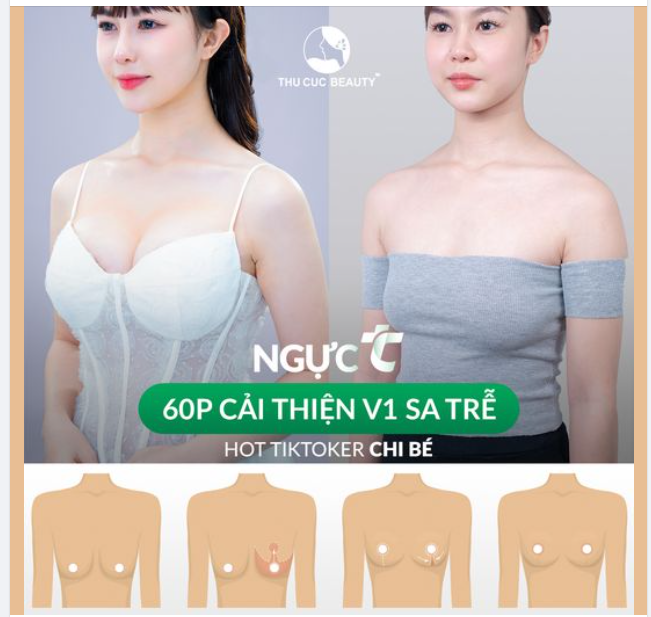 Hô biến V1 sa trễ thành V1 đẹp tự nhiên Chọn Ngực TC